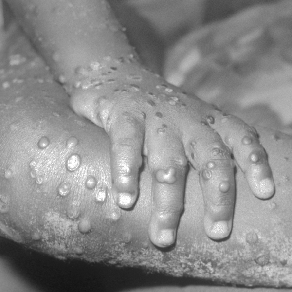 Monkeypox is not ‘vaccine acquired’ shingles