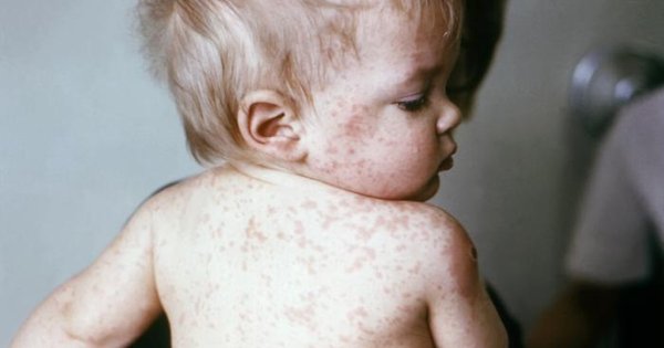 15_jan_2023_young_boy_with_measles.jpeg