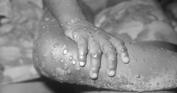 monkeypox.png