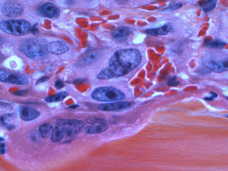 An image of cancer cells under a microscope.